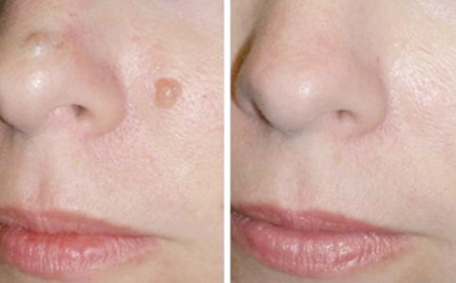 Mẹo hay xóa nhanh nốt ruồi xấu xí với 2 nguyên liệu đơn giản trong bếp
