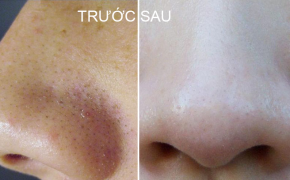 Bí quyết siêu thần thánh giúp mụn đầu đen không thể xuất hiện