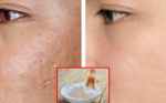 Mất hoàn toàn sẹo rổ, sẹo mụn chỉ với 1 ít baking soda!