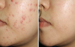 Mụn sưng tấy, chỉ 1 đêm sử dụng nguyên liệu này cũng sạch trơn!
