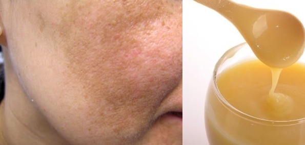5 CÔNG THỨC TRỊ NÁM NỔI TIẾNG HIỆU QUẢ CHỈ TRONG 1 THÁNG CỦA NGƯỜI HÀN