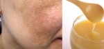 5 CÔNG THỨC TRỊ NÁM NỔI TIẾNG HIỆU QUẢ CHỈ TRONG 1 THÁNG CỦA NGƯỜI HÀN