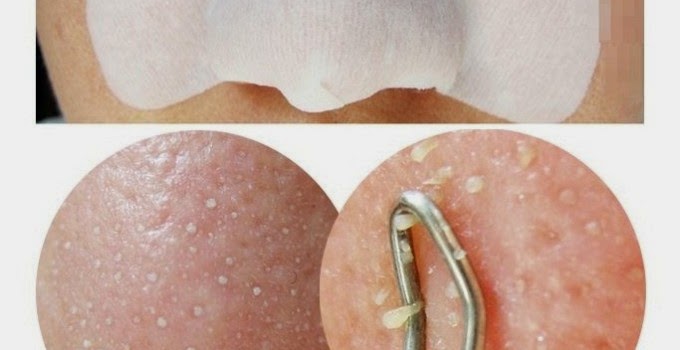 Các bí quyết trị mụn đầu đen tại nhà trong vòng 5 phút lại không hề tốn kém