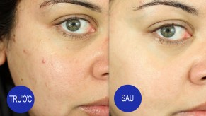 Bật mí cách chữa mụn và vết thâm chỉ trong 2 tuần