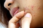 7 LOẠI MỤN CÓ NGỨA TAY CÁCH MẤY CŨNG KHÔNG ĐƯỢC NẶN