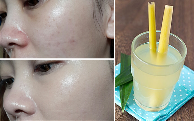 Hướng dẫn xông hơi với sả loại trừ tận gốc mụn. Không hay không lấy tiền!