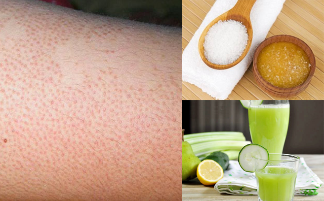 Lỗ chân lông thâm đen biến mất siêu nhanh với mẹo cực đơn giản