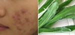 Kinh nghiệm trị mụn bằng lá ngò gai của cô gái được hàng ngàn lượt like trên MXH