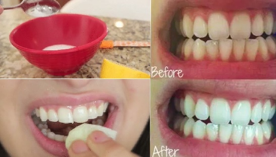 Chà nguyên liệu này trong 5 phút bạn sẽ có ngay hàm răng trắng sáng vạn người mê