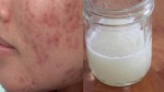 Đánh bay sẹo thâm lâu năm với cách ai cũng có thể làm được