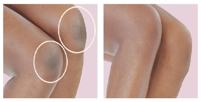 Loại Bỏ Da Chết Ở Khuỷu Tay Và Đầu Gối Với Những Cách Sau Đây