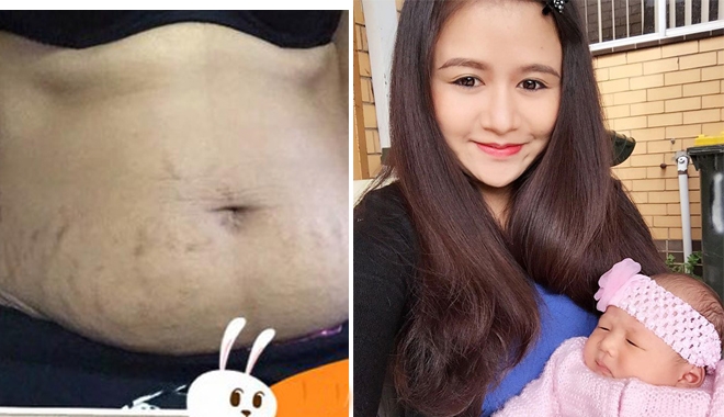 CÔNG THỨC XÓA VẾT RẠN DA ĐƠN GIẢN MÀ HIỆU QUẢ BẤT NGỜ CỦA MẸ VIỆT Ở ÚC