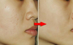 10 bí quyết đơn giản giúp trị sẹo mụn để lại trên da