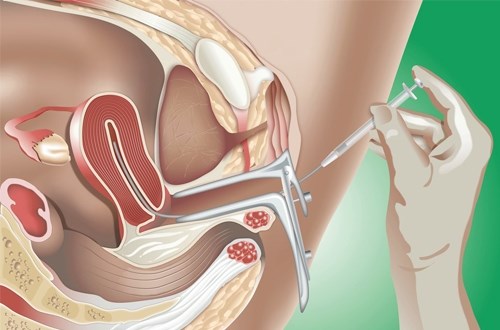 Tăng khả năng thụ thai lên gấp 3 lần, tưởng khó mà chẳng có gì khó