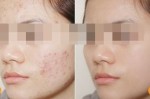 Làm mờ mọi vết thâm mụn trên mặt chỉ với 1 ngàn đồng