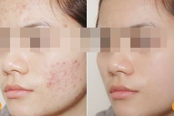 Làm mờ mọi vết thâm mụn trên mặt chỉ với 1 ngàn đồng
