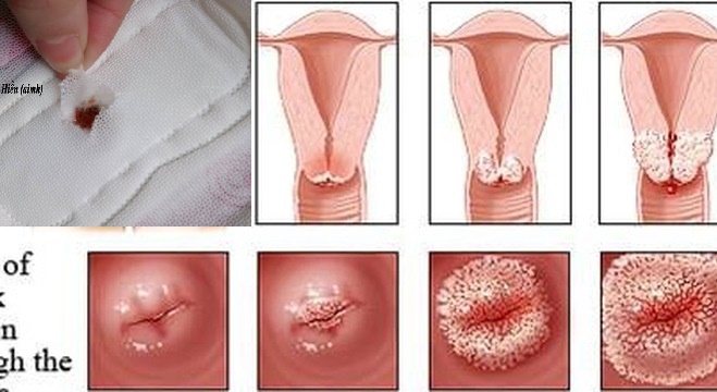 Ung thư cổ tử cung vì mỗi tháng làm việc này 1 lần