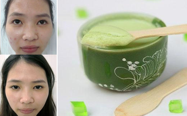 Mẹo trị mụn trứng cá cấp tốc, 1 ngày lặn ngay!