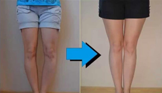 Chân bị cong làm sao cho thẳng?