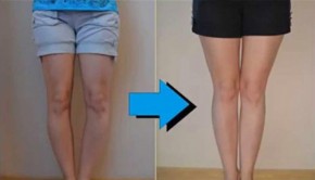 Chân bị cong làm sao cho thẳng?