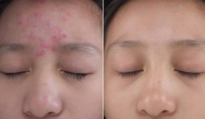 Đánh bay tất cả các loại mụn trên mọi loại da chỉ với 1 thìa thứ này