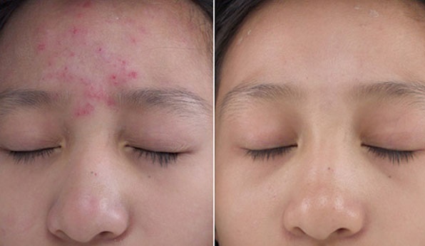 Đánh bay tất cả các loại mụn trên mọi loại da chỉ với 1 thìa thứ này