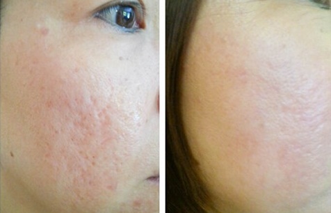 3 công thức trị khỏi “sẹo lõm” vĩnh viễn dù đã bị cả chục năm