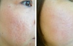 3 công thức trị khỏi “sẹo lõm” vĩnh viễn dù đã bị cả chục năm