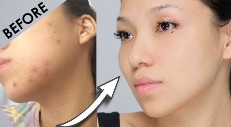 Đảm bảo hết sạch thâm do mụn để lại nếu bạn biết hỗn hợp này