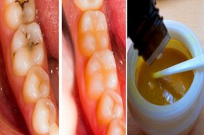 Cách trị dứt điểm sâu răng, mảng bám và giúp răng siêu trắng tại nhà