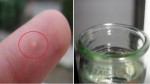 Trị mụn ẩn dưới da với nước và chai nhựa chưa tới 3 phút