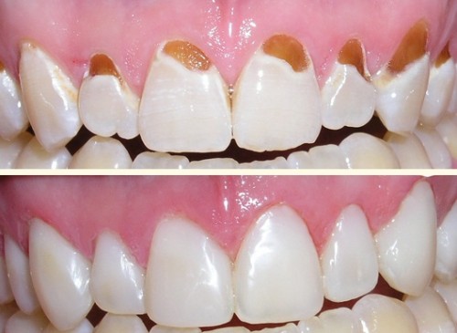 Hết hôi miệng, mảng bám răng chỉ sau 5 phút