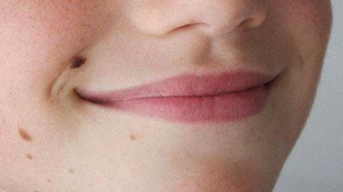 10 biện pháp tẩy nốt ruồi tại nhà không cần tốn tiền đốt điện