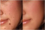 7 Tuyệt chiêu tẩy nốt ruồi nhanh chóng không để lại sẹo tại nhà