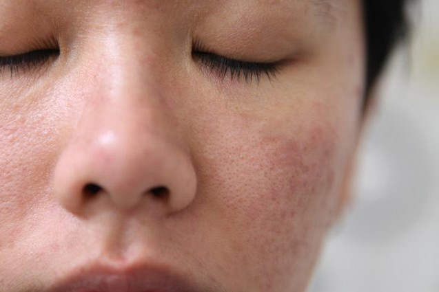 Cách trị mụn và se khít lỗ chân lông cực dễ