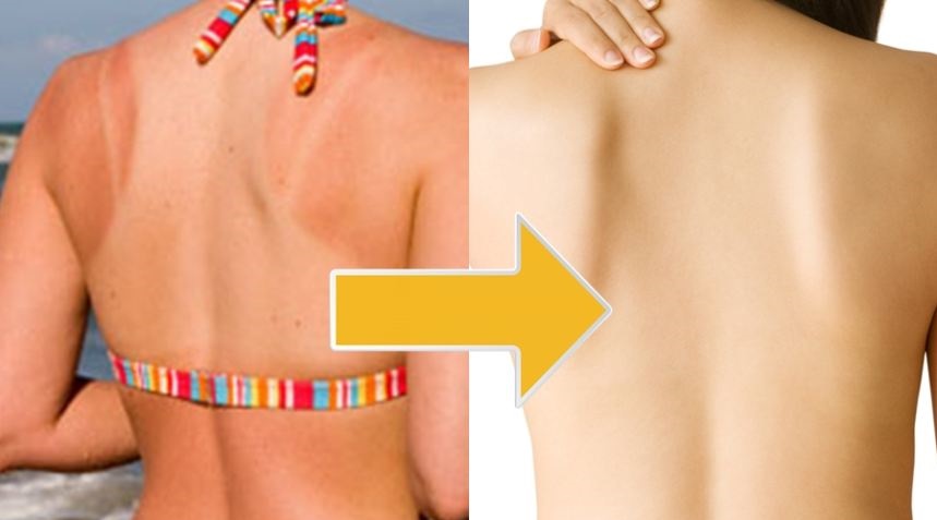 2 bí kíp đơn giản giúp da đen vì cháy nắng nhanh chóng trắng mịn trở lại