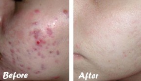 Tận diệt mụn đơn giản với một thứ nguyên liệu ai cũng biết