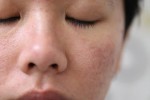 Cách trị mụn và se khít lỗ chân lông cực dễ