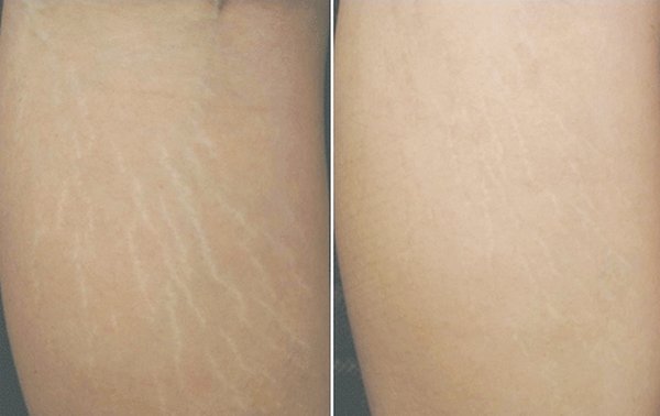 Làm cách này bạn sẽ hết rạn da mà không cần đi thẩm mỹ