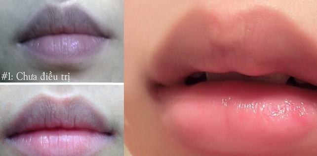 Nhìn môi đoán bệnh và cách tự nhiên trị môi thâm chị em nên biết