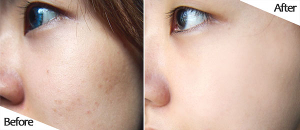 Loại củ quả quen thuộc mà bạn không nghĩ sẽ trị được nám