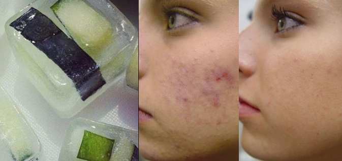 Công thức đá viên trị mụn tự nhiên dành cho chị em