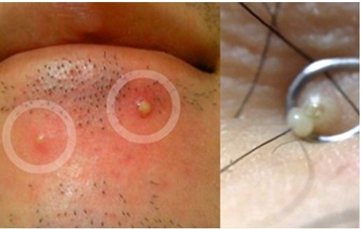 99&permil; người nặn mụn cố lấy bằng được thứ mủ màu trắng mà không biết sự thật kinh hãi này!
