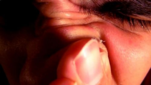 Cách thổi bay mụn đầu đen tự nhiên hiệu quả và không đau đớn