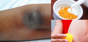 Tạm biệt thâm đầu gối, khuỷu tay chỉ trong 1 lần áp dụng