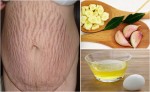 Xóa tan vết rạn da sau sinh chỉ với tỏi, lòng trắng trứng gà và hoa cúc