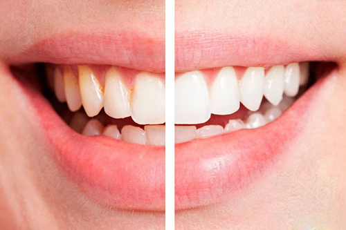 Với các nguyên liệu dễ kiếm, bạn sẽ không cần đến nha sĩ lấy cao răng