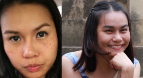 TOP 3 KEM TRỊ NÁM – TÀN NHANG ĐƯỢC ƯA THÍCH NHẤT