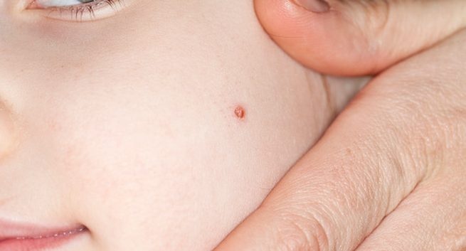 Dấu hiệu nhận biết mụn cóc do nhiễm virus HPV bạn không nên chủ quan