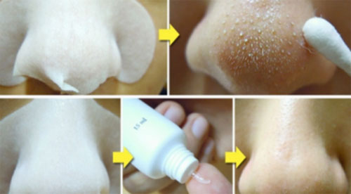 Mụn đầu đen sẽ biến mất trong “tích tắc” với cách thức đơn giản này